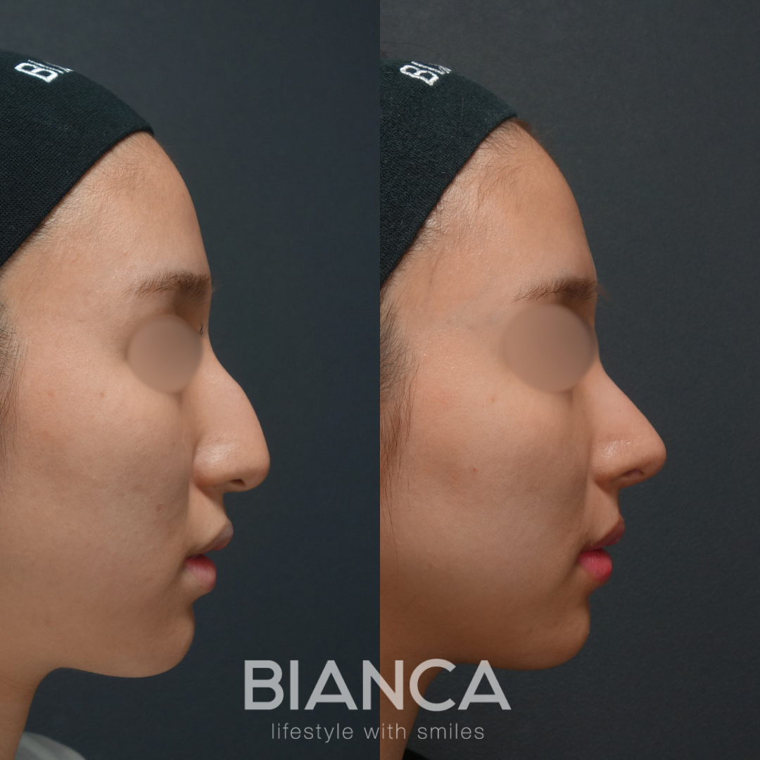 ハンプ切除＋鼻骨骨切り幅寄せ